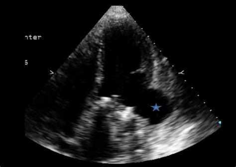 lv angiogram|lv aneurysm vs pseudoaneurysm echo.